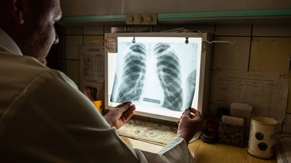 В Україні з'являються випадки позалегеневого туберкульозу - ЦГЗ