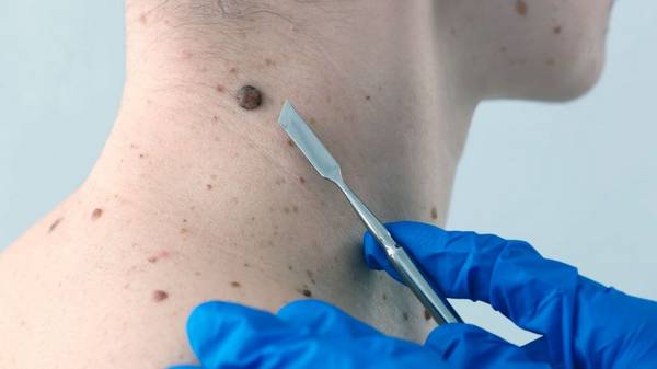 Доброкачественные новообразования кожи: почему появляются и как от них...