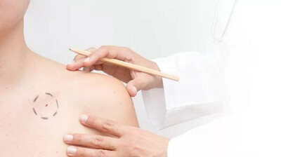 Доброкачественные новообразования кожи: почему появляются и как от них